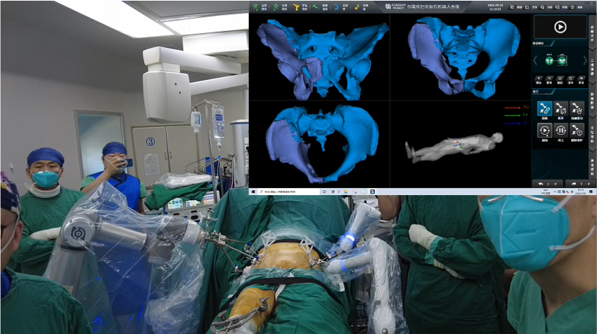 羅森博特| 智能化手術機器人成功治療92歲高齡骨盆骨折患者